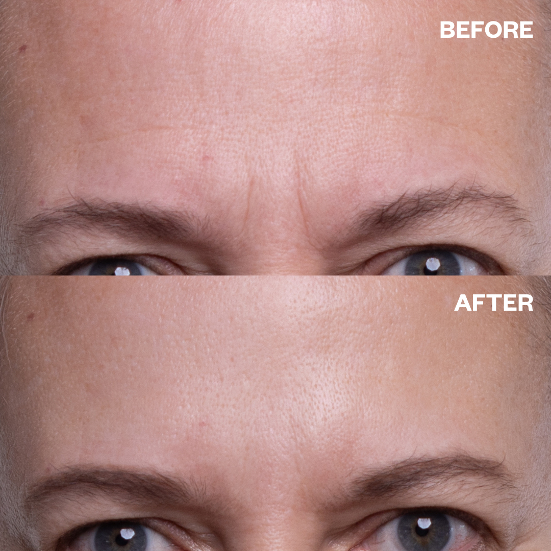 Re-usable Silicone Forehead Wrinkle Patches